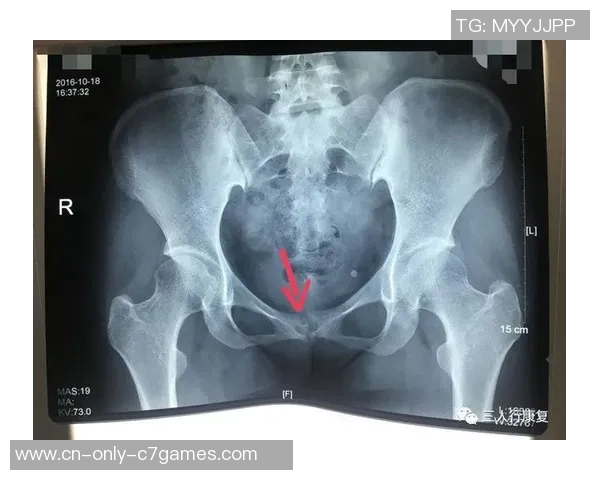 米体：吉尔摩考虑手术医治耻骨炎，或许缺席至下一年一月